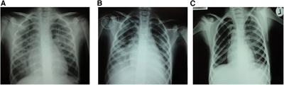 Case report: Suspected transfusion-related acute lung injury type II in a child with refractory systemic juvenile idiopathic arthritis complicated by macrophage activation syndrome